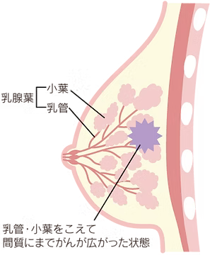 非浸潤がんのイラスト