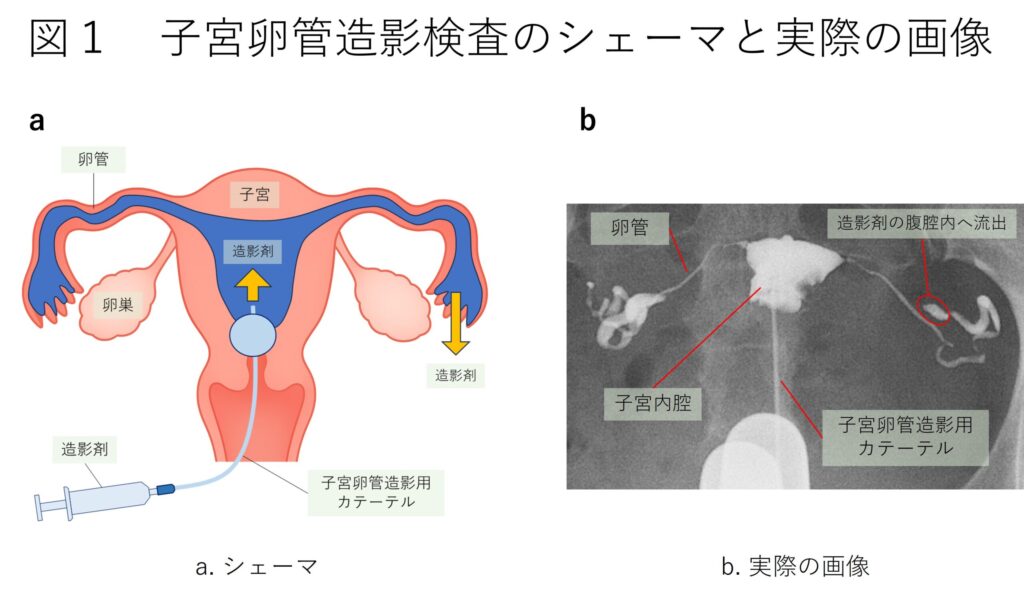 子宮卵管造影検査について｜効果や、痛みなどの副作用の説明、料金まで、幅広く解説します